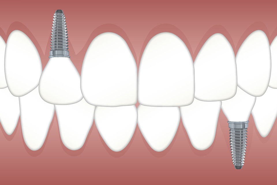 De voordelen en kosten van implantaten