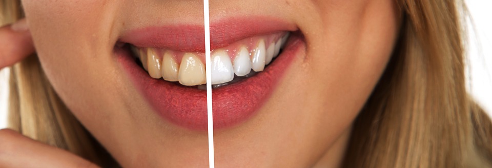 Tanden bleken: zelf of met behulp van een tandarts?